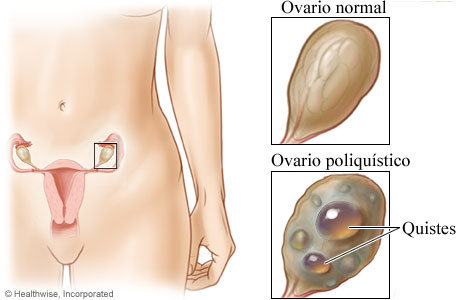 Como saber si tengo síndrome de ovarios poliquisticos