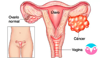 como detectar cancer de ovarios
